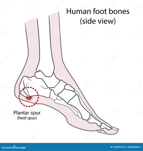 Plantar Spur Calcaneal Spur. Human Foot Bones. Illustration Isolated On A White Background Stock ...