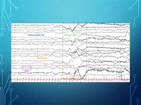 Infantile Spasms.ppt