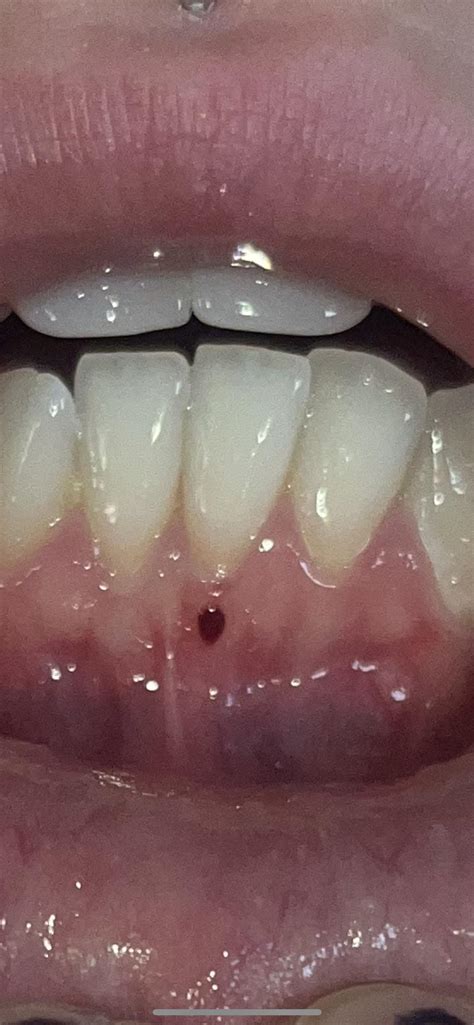 blood blister on gum? : r/askdentists