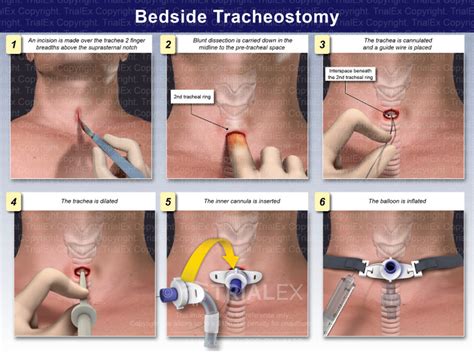 Image result for Trach Procedure