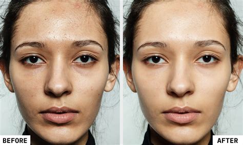 Chemical Peeling Cost In India - Treatment, Process