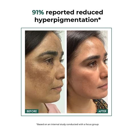 Shop Acne Marks & Pigmentation Control Kit for Healthy & Glowing Skin ...