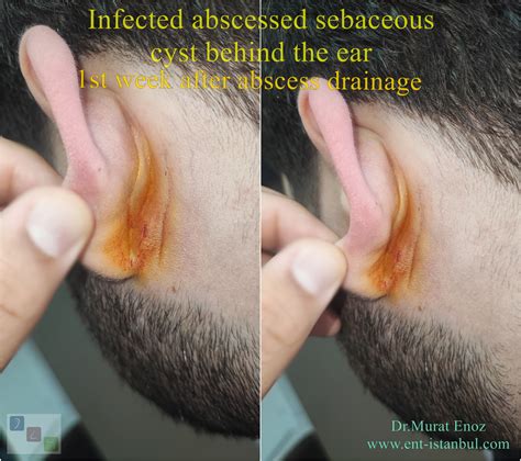Infected Epidermal Inclusion Cyst (Sebaceous Cyst) Of The Ear