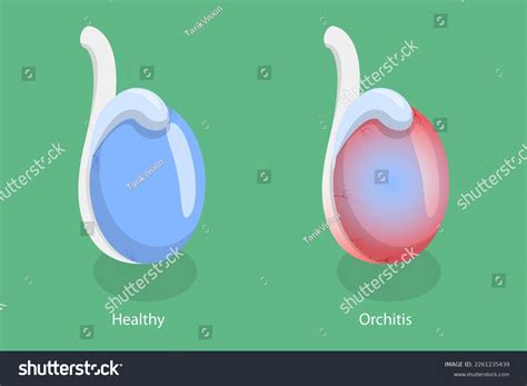 6 Undescended Testicle Concept Images, Stock Photos, 3D objects ...