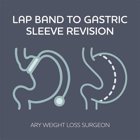 Weight Loss Procedures – AryBariatrics