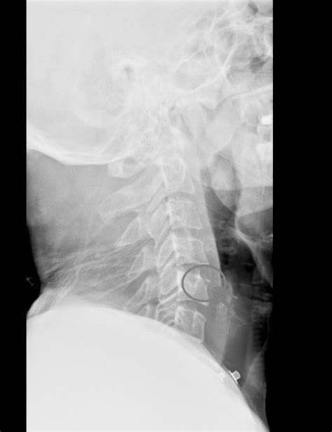 Limbus vertebrae of the cervical spine: A case report - Pappa - 2022 - Clinical Case Reports ...