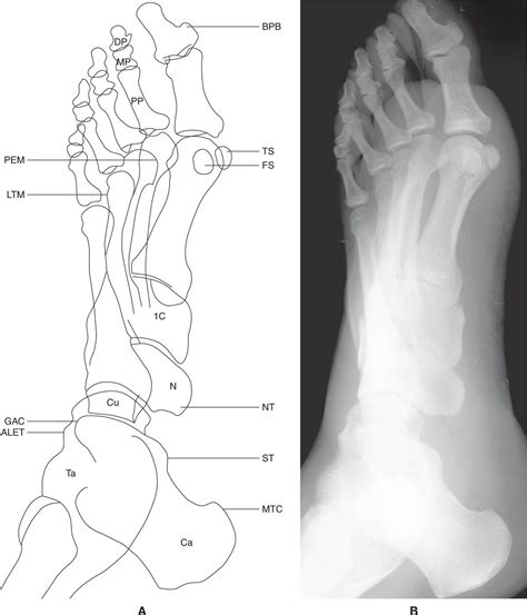 Normal Foot 的图像结果