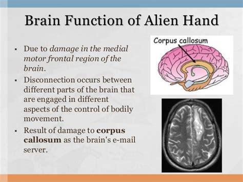 Image result for Alien Arm Syndrome