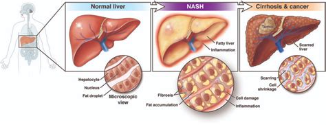 First drug to treat non-alcoholic steatohepatitis UPSC