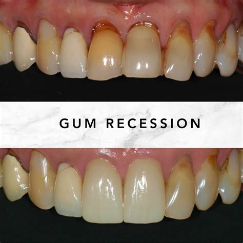 Correcting The Black Border At The Gumline Of Crowns – Before And After - Geach Dental