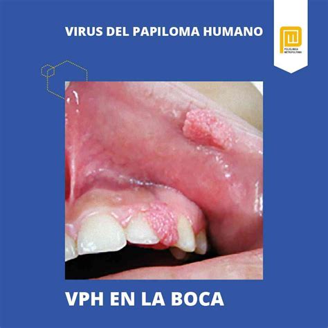 Virus del Papiloma Humano: Síntomas y tratamiento – Policlinica ...