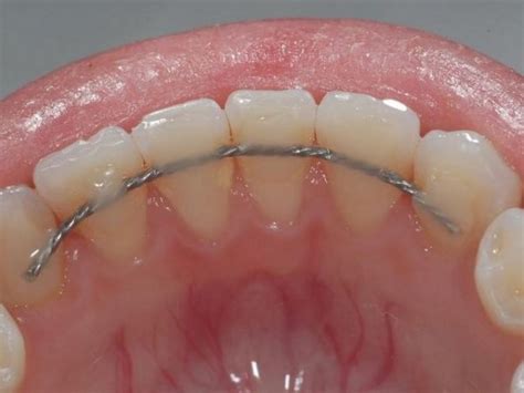 Image result for Retainer Problems