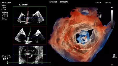 EPIQ CVxi Cardiac Ultrasound