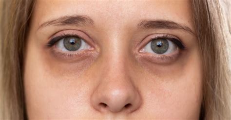 Indian Diet Plan to Reduce Dark Circle or Under Eye Bags – Eyecirque Store