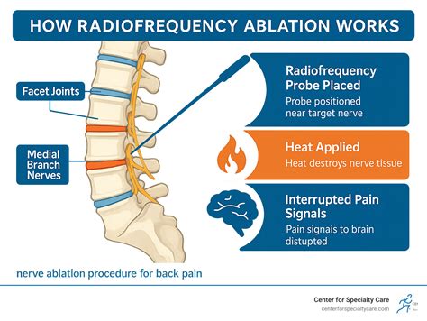 Nerve ablation procedure for back pain: Maximize Relief 2025