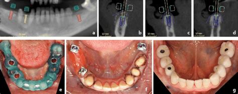 Robotic computer-assisted implant surgery promising for placing dental ...