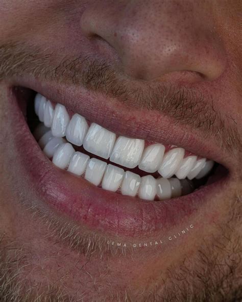 Carillas Dentales - Lema Clínica Dental Turquía 2026