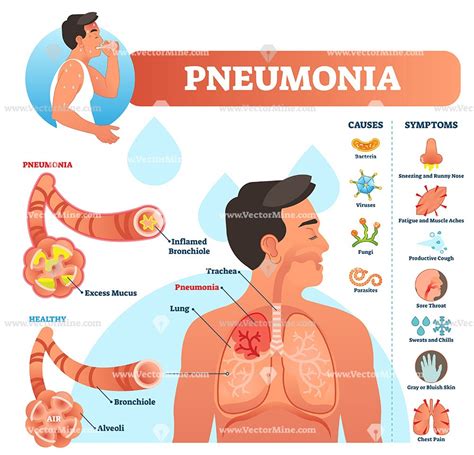 Pneumonia anatomical vector illustration infographic diagram | Pneumonia, Pneumonia symptoms ...