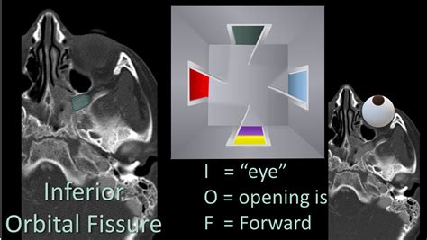 Inferior Orbital Fissure Radiology CT Of The Orbit: Anatomy