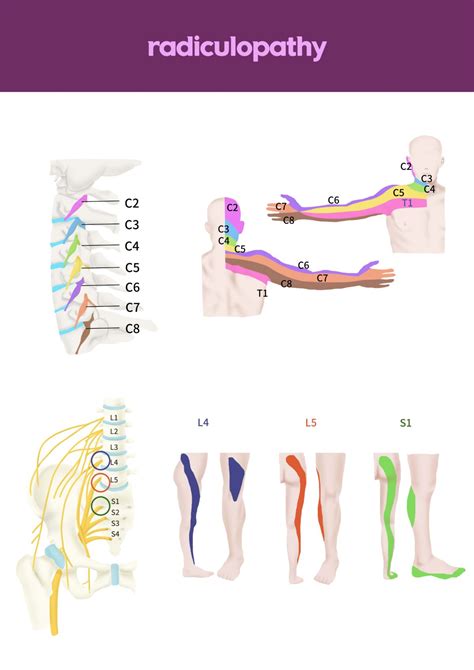 Lumbar Radiculopathy Referral Pattern – IJUJ