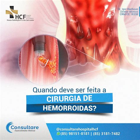 O que causa hemorroida e como tratar?