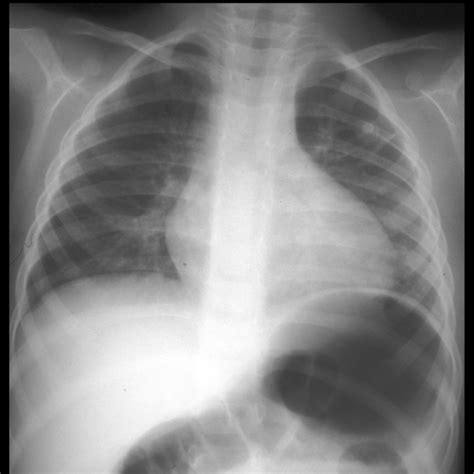 Pediatric Right Aortic Arch With Aberrant Left Subclavian Artery | Pediatric Radiology Reference ...