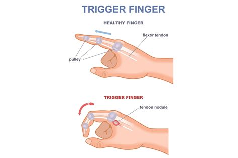 Why My Finger Joints Hurt