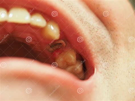 Image result for Root Extraction Tooth Broken Off
