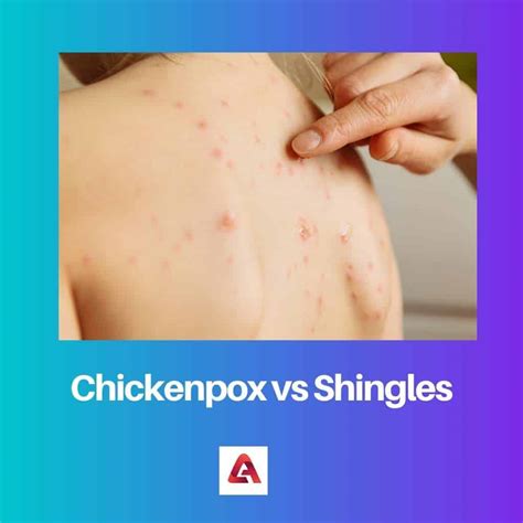 Chickenpox vs Shingles: Difference and Comparison