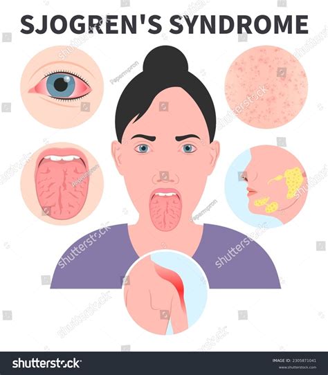 Sjogrens Syndrome Dry Eye Lymph Nodes Stock Vector (Royalty, 55% OFF