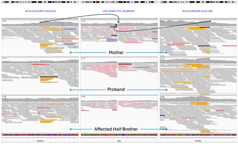 Duchenne Muscular Dystrophy in Two Half-Brothers Due to Inherited 306 ...