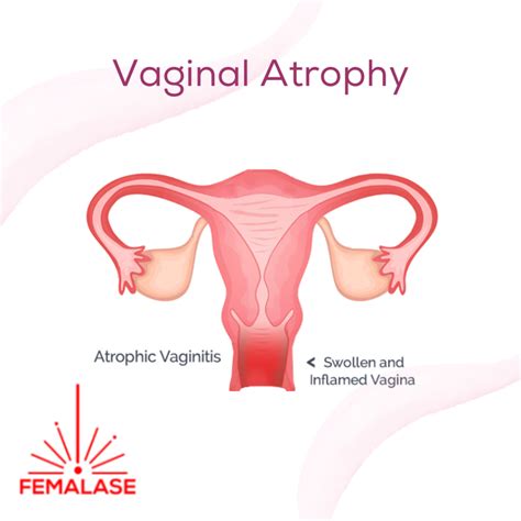 Natural Treatment for Vaginal Atrophy - Femalase