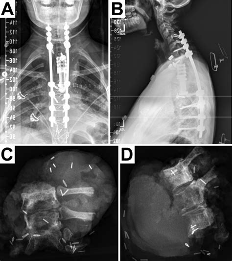 Image result for Clamshell Thoracotomy