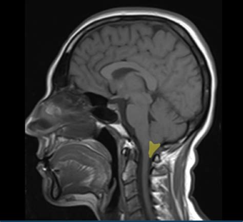 Cisterna Magna Anatomy