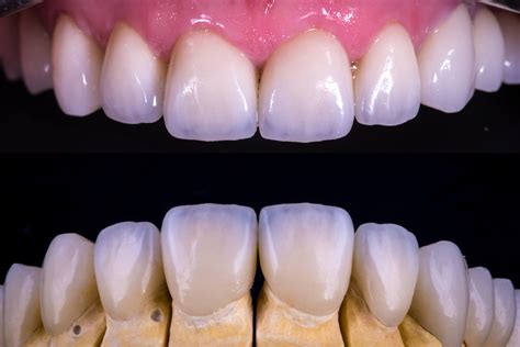 Why Zirconia are the Best Choice: Dental Crowns & Bridges | Manila