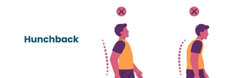 Understanding Hunchback (kyphosis): Types and Symptoms