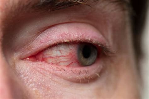 Blepharitis (Eyelid Inflammation): Symptoms, Causes and Treatment