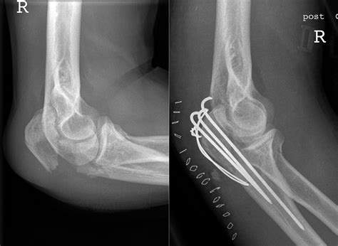 Olecranon Fractures - Pathophysiology - Management - TeachMeSurgery