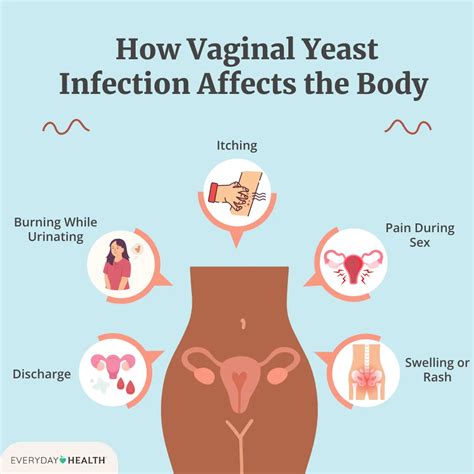 Yeast Infection Treatment