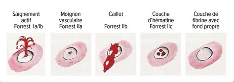 Maladie ulcéreuse gastroduodénale - Contenu en francais - Universimed ...