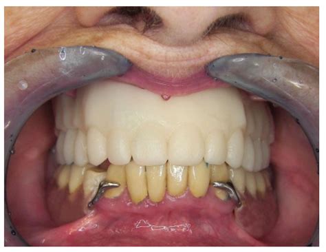 Current Status of Digital Complete Dentures Technology