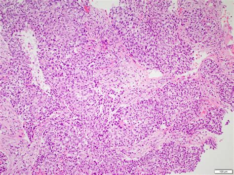 Squamous Cell Carcinoma Lung Histology Squamous Cell Carcinoma Of The