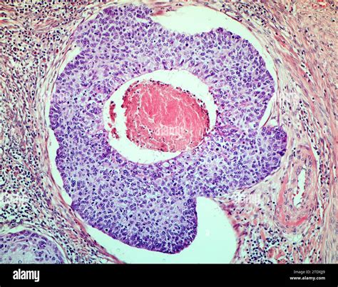 Cervical cancer. Light micrograph (LM) of a section through an HSIL (High-grade squamous ...