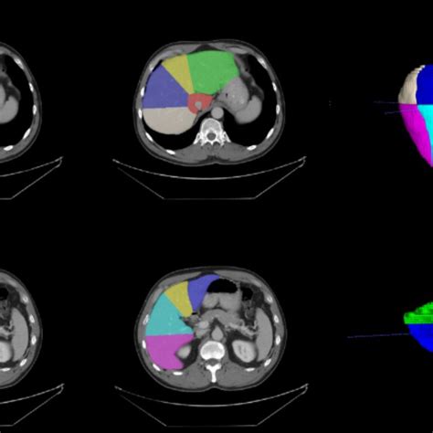 Image result for Decathlon Brain Segmentation Code