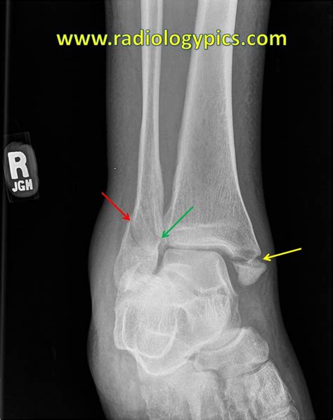 Lauge Hansen SER IV - Ankle mortise view shows fracture of the medial ...