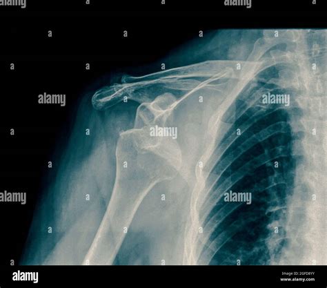 X ray dislocated shoulder hi-res stock photography and images - Alamy