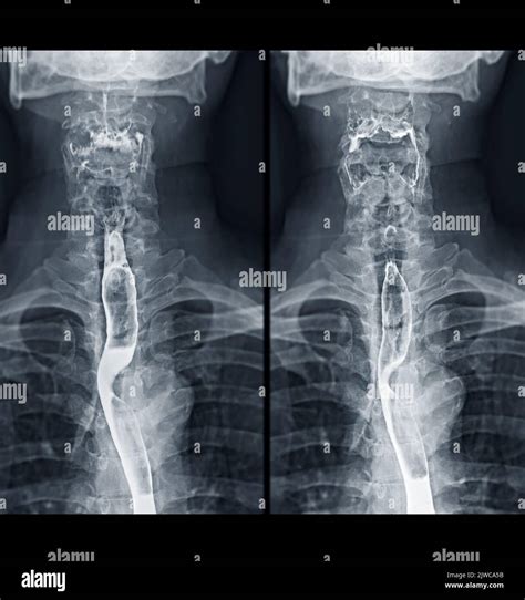 X-Ray Barium Swallow Procedure at Sophie Clarkson blog