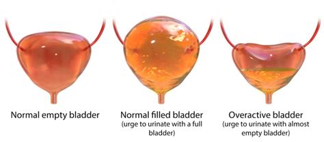Bladder Spasms 的图像结果