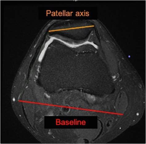 Patellar Tilt and Patellar Tendon–Trochlear Groove Angle Present the Optimum Magnetic Resonance ...