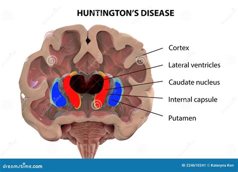 Coronal Section of a Brain of a Person with Huntington`s Disease Stock ...
